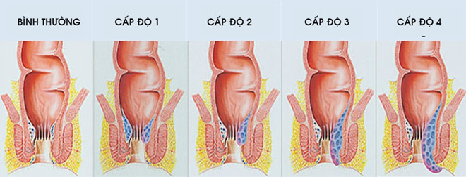 bệnh trĩ để lâu có sao không