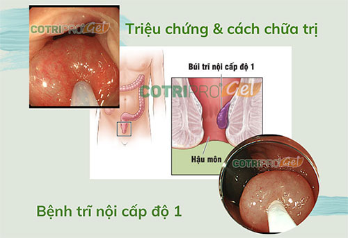 Bệnh trĩ nội độ 1: Triệu chứng & cách chữa đơn giản tại nhà