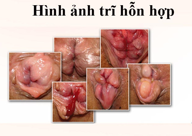 Hình ảnh bệnh trĩ hỗn hợp