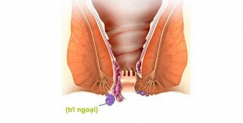 Nguyên nhân hình thành bệnh trĩ ngoại 1