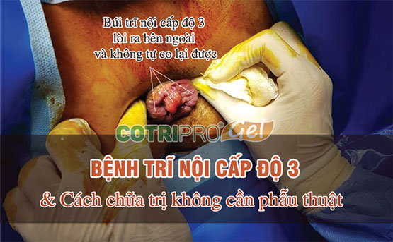 Trĩ nội độ 3: Triệu chứng, phẫu thuật không? cách điều trị