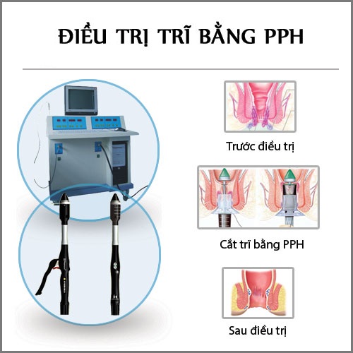 4.1 Cắt trĩ bằng phương pháp PPH hết bao nhiêu tiền? 1