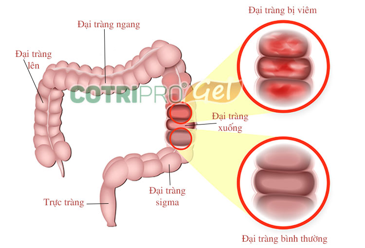 3.1 Bệnh viêm đại tràng 1