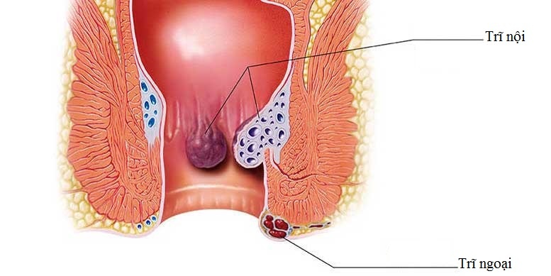 Những hậu quả nguy hiểm của bệnh trĩ không thể coi thường