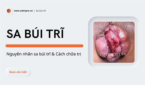 Sa búi trĩ là gì? Triệu chứng và cách chữa trị hiệu quả tại nhà