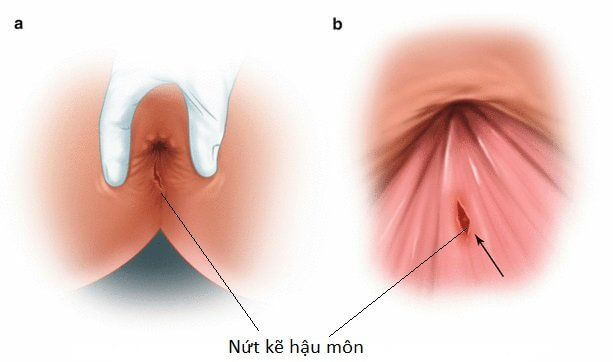 Nứt kẽ hậu môn: Triệu chứng, cách điều trị, bao lâu thì lành