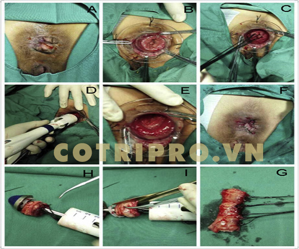 cắt trĩ bằng phương pháp pph