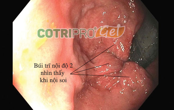 sa búi trĩ nội độ 2