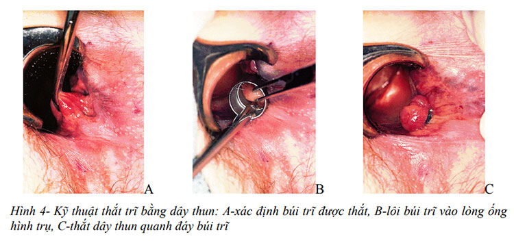 thắt búi trĩ