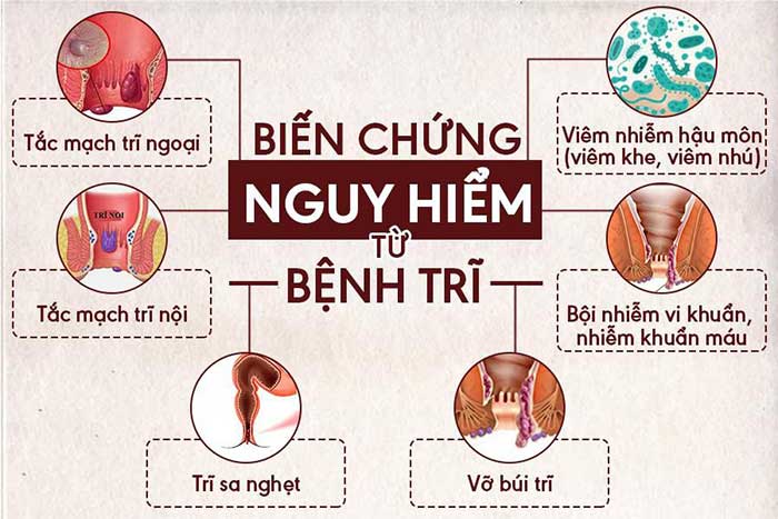 Bệnh trĩ có chữa được không