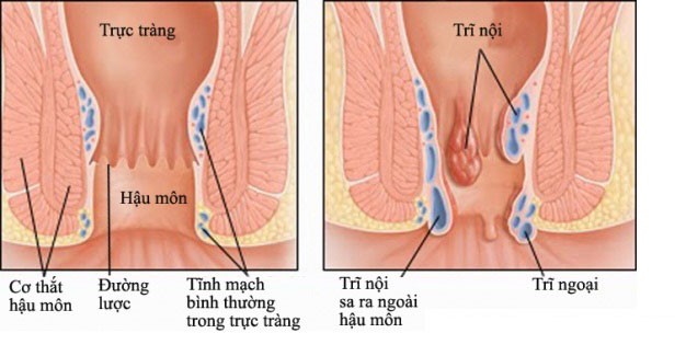 Cách Phân Biệt Trĩ Nội Và Trĩ Ngoại Khác Nhau Như Thế Nào