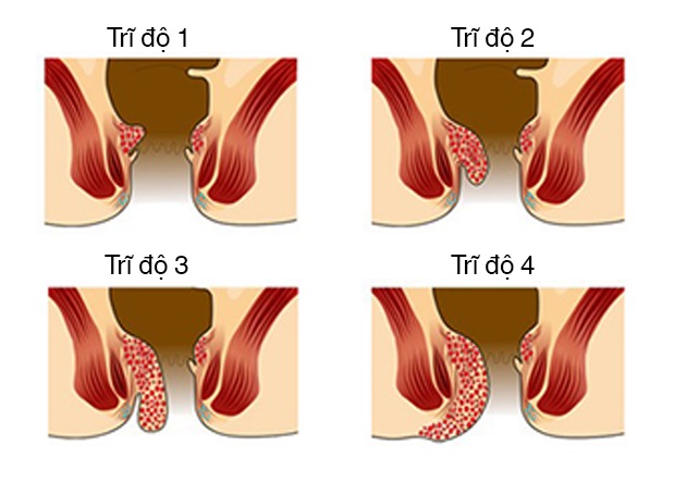 phân biệt trĩ và ung thư đại tràng