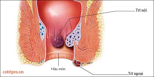 táo bón có thể gây bệnh trĩ