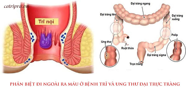 Phân biệt bệnh trĩ và ung thư đại trực tràng