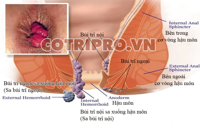 Sa búi trĩ - Triệu chứng điển hình của trĩ 1