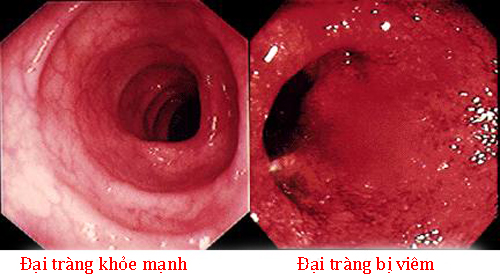 2.5 Viêm loét đại tràng 1