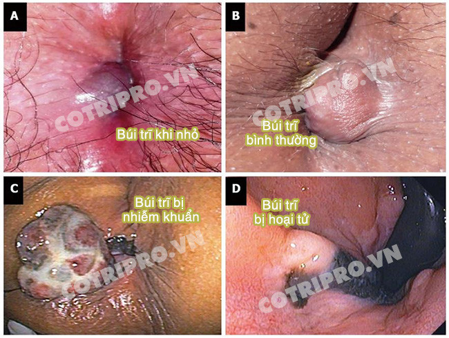 Biến chứng của bệnh trĩ