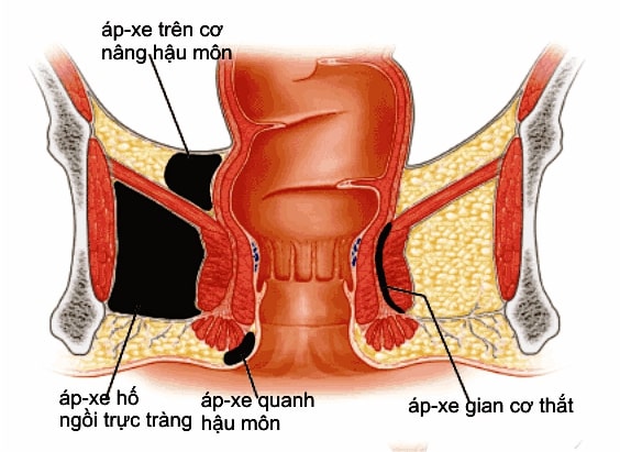 Phân loại áp xe hậu môn 1