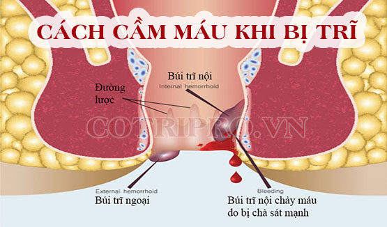 #6 Cách cầm máu khi bị trĩ tức thì nhanh chóng, hiệu quả