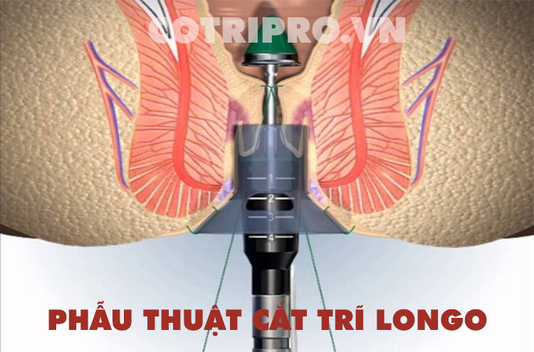 phẫu thuật trĩ vòng