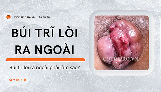 Bị trĩ lòi ra ngoài phải làm sao? Cách làm co búi trĩ nhanh