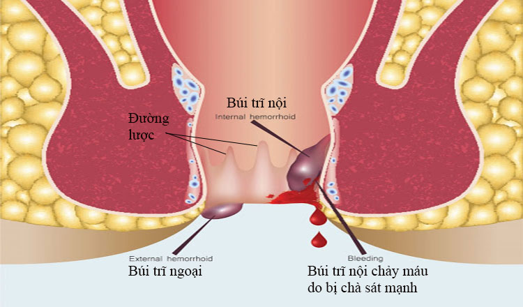 trĩ tái phát sau phẫu thuật