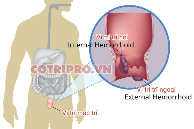 phân biệt trĩ nội và trĩ ngoại