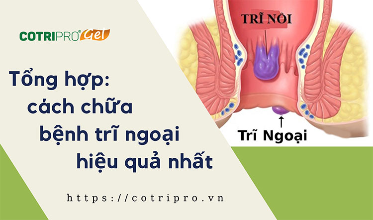 #10 Cách Chữa Bệnh Trĩ Ngoại Hiệu Quả Nhất Hiện Nay