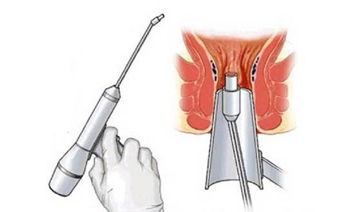 cắt trĩ bằng laser