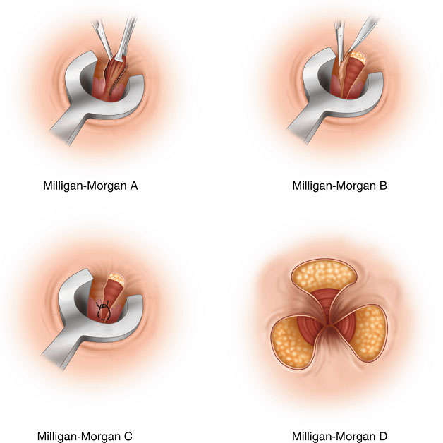 Phương pháp cắt trĩ Milligan Morgan