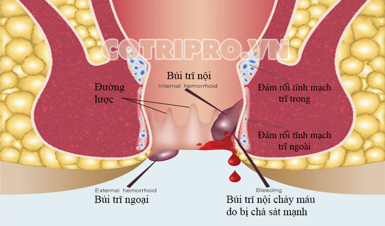 I. Đi ngoài ra máu tươi do bị trĩ là thế nào? 2