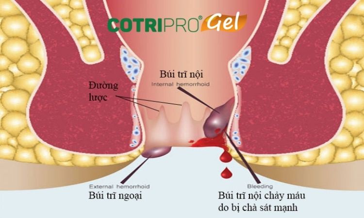 đi ỉa ra máu đông