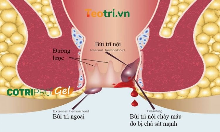 đi ngoài ra máu tươi nhỏ giọt