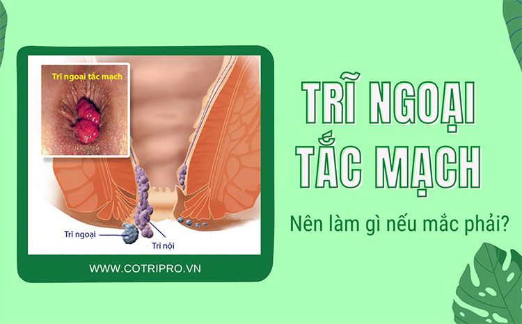 Trĩ ngoại tắc mạch (trĩ ngoại nhồi máu) là gì? Cách điều trị