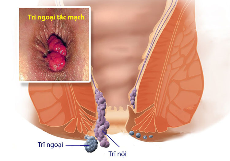 tắc mạch trĩ ngoại