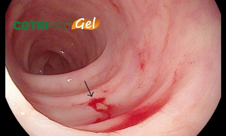 đi đại tiện ra cục máu đông