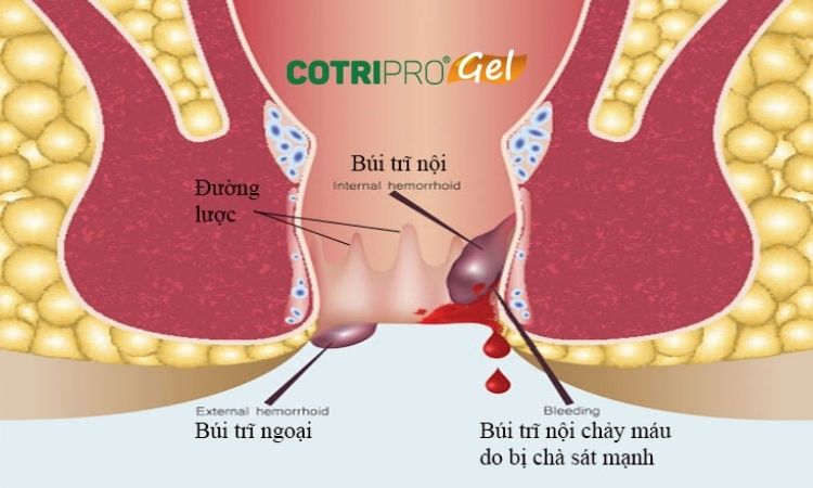 Tìm hiểu về bệnh trĩ 1