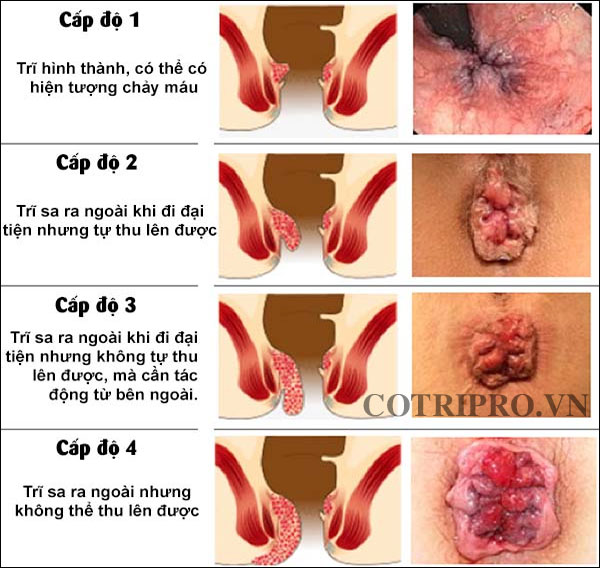 điều trị trĩ cấp