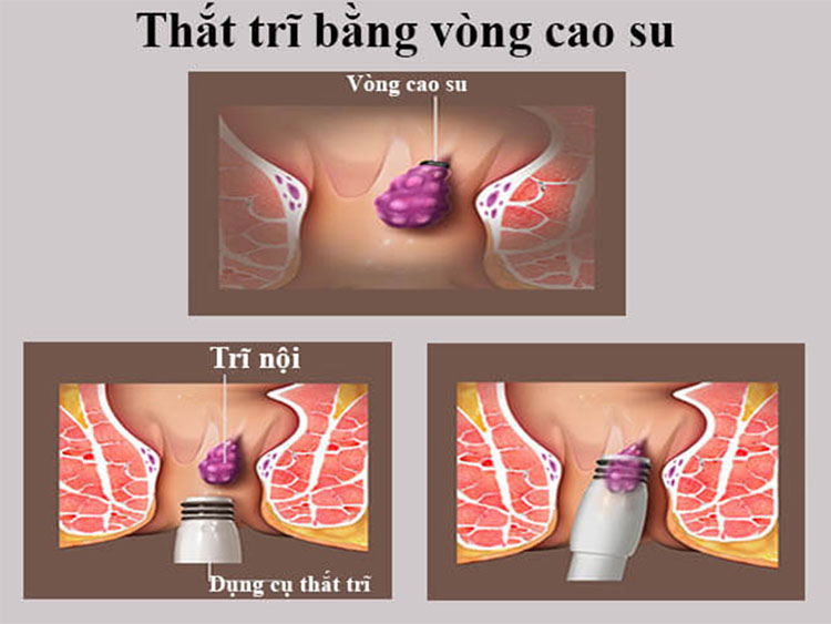 6.1 Thắt búi trĩ bằng vòng cao su với các búi trĩ nội 1