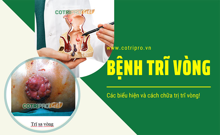 Bệnh trĩ vòng là gì? Nguyên nhân, triệu chứng, cách điều trị