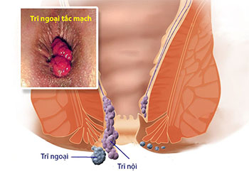 2.2 Biến chứng tắc mạch trĩ ngoại 1