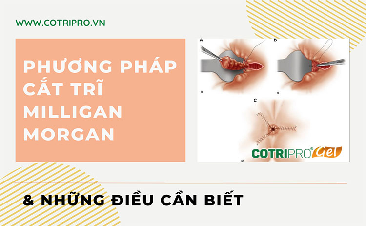 Phương pháp cắt trĩ Milligan Morgan: Ưu - Nhược điểm