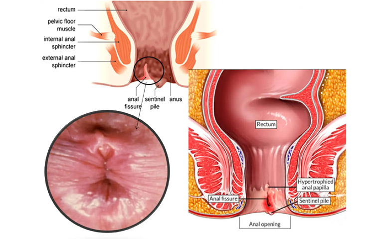 Nứt kẽ hậu môn