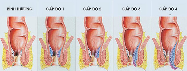 Các cấp độ bệnh trĩ