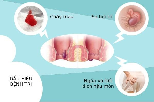 Cách điều trị bệnh trĩ không cần phẫu thuật