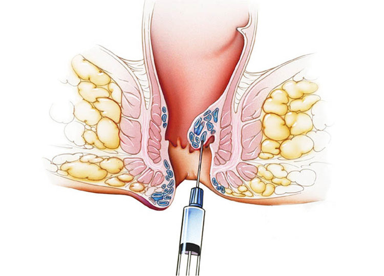  điều trị trĩ nội độ 3