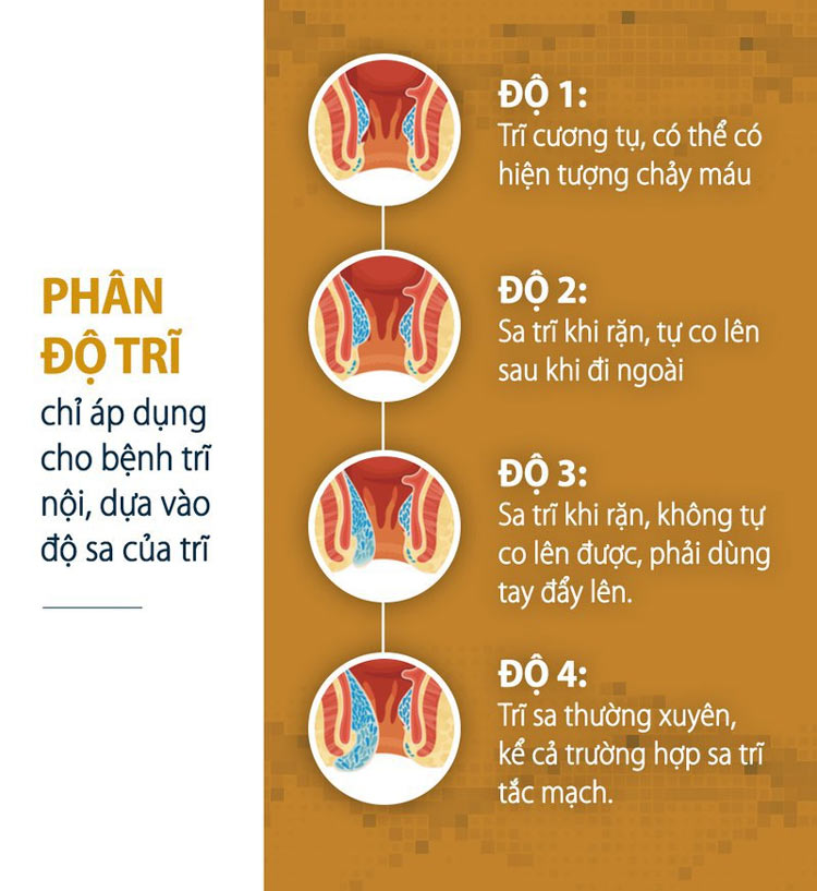 các cấp độ của bệnh trĩ nội