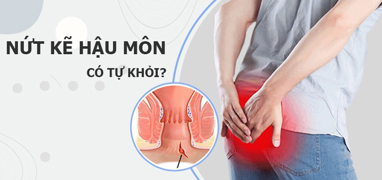 nứt kẽ hậu môn có tự khỏi