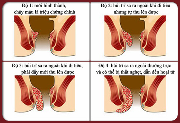 Trĩ lòi ra ngoài phải làm sao