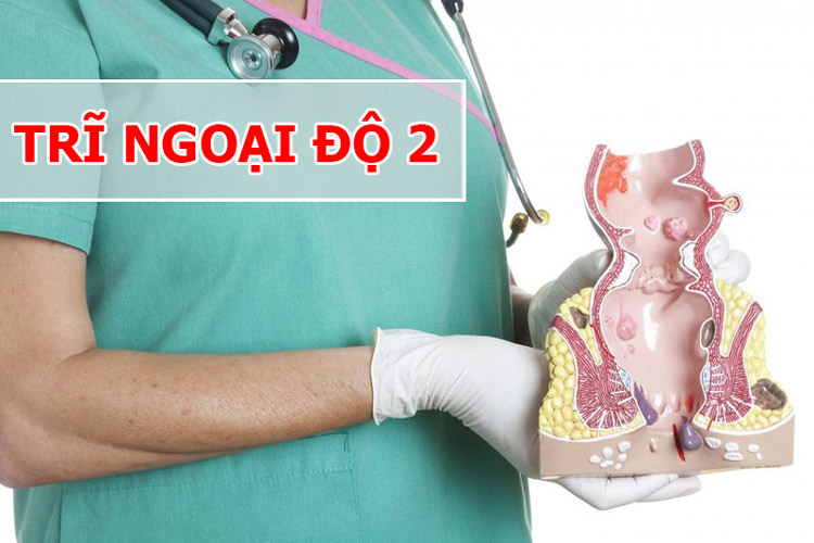 Trĩ ngoại độ 2: Triệu chứng, tự khỏi không? cách điều trị